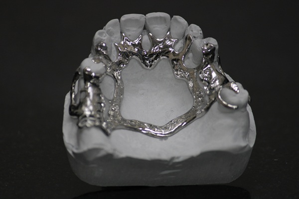 cast-partial-denture